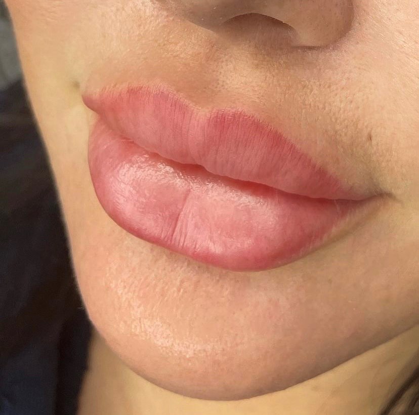 Lip Treatment